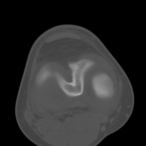 Brodie abscess of the tibia (Radiopaedia 58984-66250 Axial bone window 54).jpg