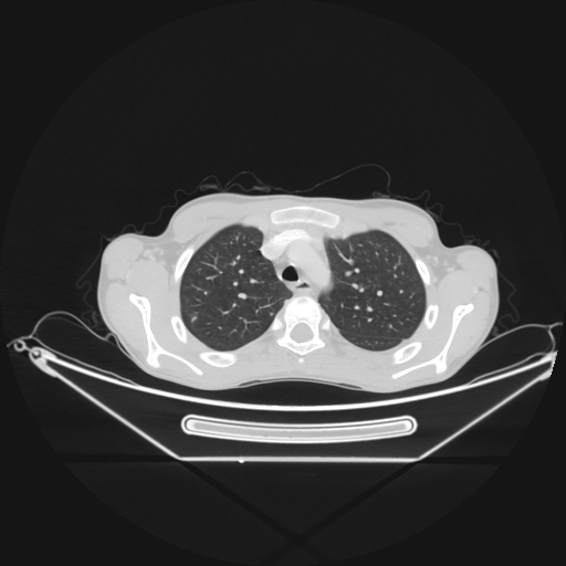 Bronchial carcinoid tumor (Radiopaedia 57187-64090 Axial lung window 15).jpg