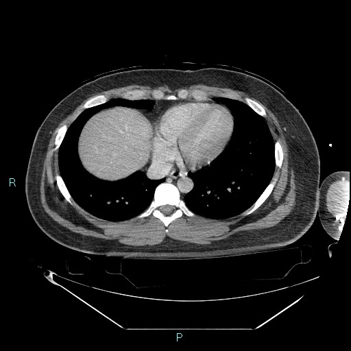 Bronchial carcinoid tumor (Radiopaedia 78272-90870 C 87).jpg