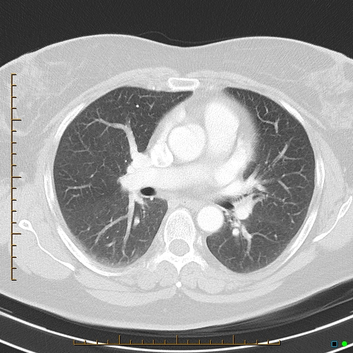 Bronchial diverticula (Radiopaedia 79512-92675 Axial lung window 23).jpg