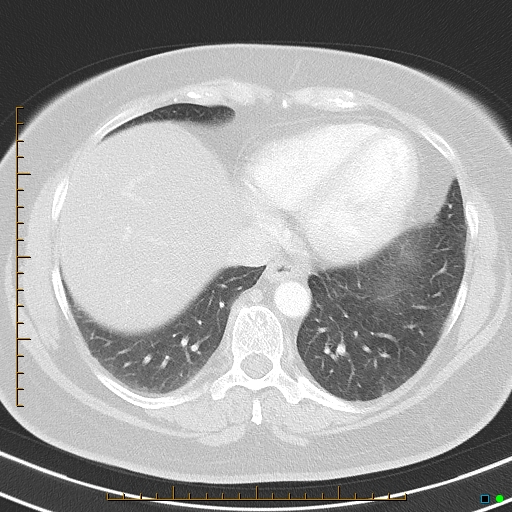File:Bronchial diverticula (Radiopaedia 79512-92675 Axial lung window 37).jpg