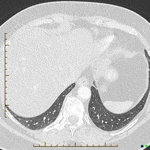 Bronchial diverticula (Radiopaedia 79512-92676 Axial lung window 177).jpg