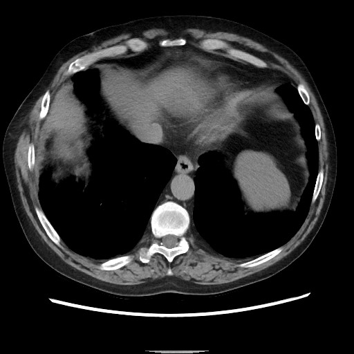 Bronchial stenosis - lung transplant (Radiopaedia 73133-83848 Axial non-contrast 49).jpg