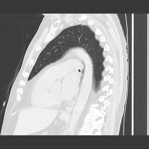 Bronchial stenosis - lung transplant (Radiopaedia 73133-83848 Sagittal lung window 41).jpg