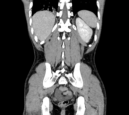 Bronchiectasis in Crohn disease (Radiopaedia 60311-67977 C 69).jpg
