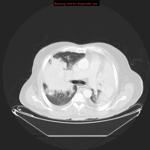 File:Bronchioloalveolar carcinoma (Radiopaedia 9272-9955 Axial lung window 13).jpg