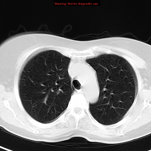 File:Bronchoalveolar carcinoma (BAC) (Radiopaedia 13436-13392 Axial lung window 15).jpg