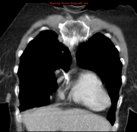 Bronchoalveolar carcinoma (BAC) (Radiopaedia 13436-13392 E 12).jpg