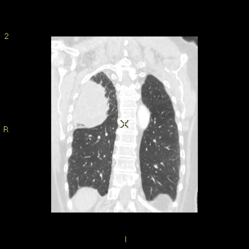File:Bronchogenic carcinoma as an incidental finding (Radiopaedia 16453-16130 Coronal lung window 38).jpg