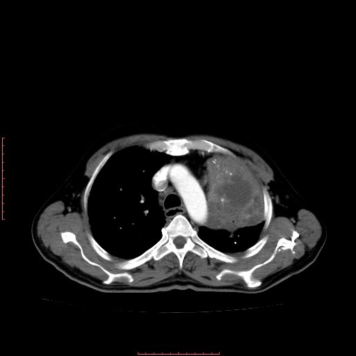File:Bronchogenic carcinoma with left atrial large deposit - T4N3M1a (Radiopaedia 42316-45428 A 10).jpg