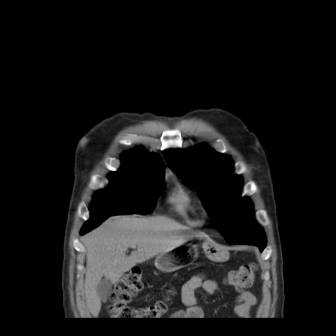 Bronchogenic carcinoma with upper lobe collapse (Radiopaedia 29297-29726 D 12).jpg