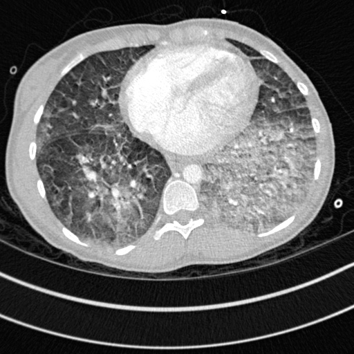 Bronchogenic cyst (Radiopaedia 77801-90071 Axial lung window 58).jpg