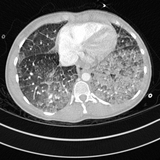 Bronchogenic cyst (Radiopaedia 77801-90071 Axial lung window 63).jpg
