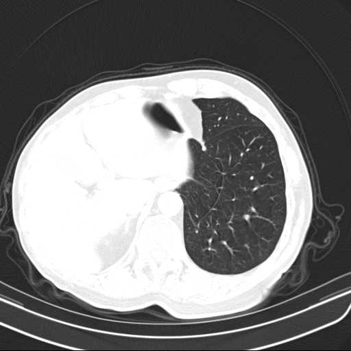 File:Bronchopleural fistula - postoperative complication (Radiopaedia 21020-20947 Axial lung window 48).jpg