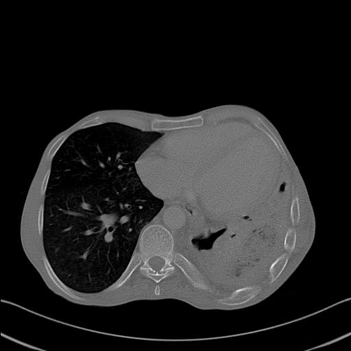 File:Bronchopleural fistula secondary to tuberculosis (Radiopaedia 20415-20322 Axial bone window 20).jpg