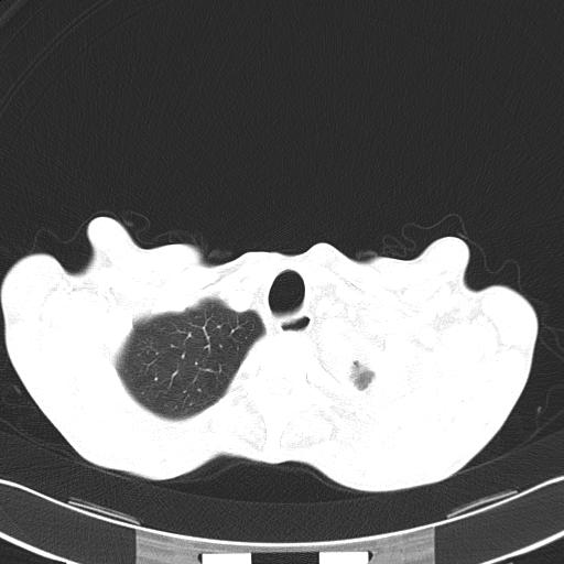 Bronchopleural fistula secondary to tuberculosis (Radiopaedia 20415-20322 Axial lung window 9).jpg