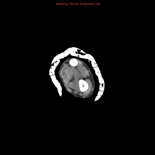 File:Brown tumor (Radiopaedia 12460-12694 Axial non-contrast 38).jpg