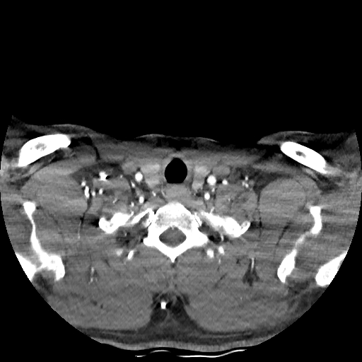 Buccal fat pad arteriovenous malformation (Radiopaedia 70936-81144 D 58).jpg