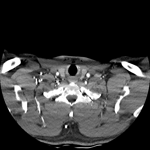 Buccal fat pad arteriovenous malformation (Radiopaedia 70936-81144 D 63).jpg