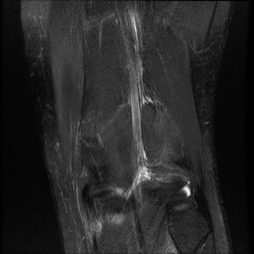 File:Bucket-handle meniscus tear (Radiopaedia 65700-74809 Coronal T2 fat sat 4).jpg