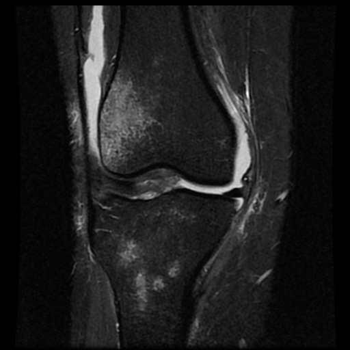 File:Bucket handle meniscus tear (Radiopaedia 56916-63751 Coronal STIR 8).jpg
