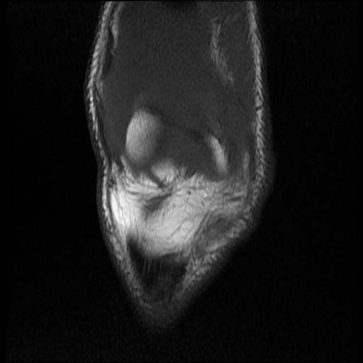 File:Bucket handle tear - medial meniscus (Radiopaedia 69245-79026 Coronal T1 4).jpg