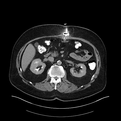File:Buried bumper syndrome - gastrostomy tube (Radiopaedia 63843-72575 Axial Inject 10).jpg