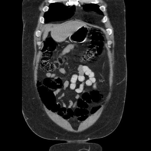 Burned-out testicular seminoma - retroperitoneal nodal metastases (Radiopaedia 62872-71245 B 15).jpg