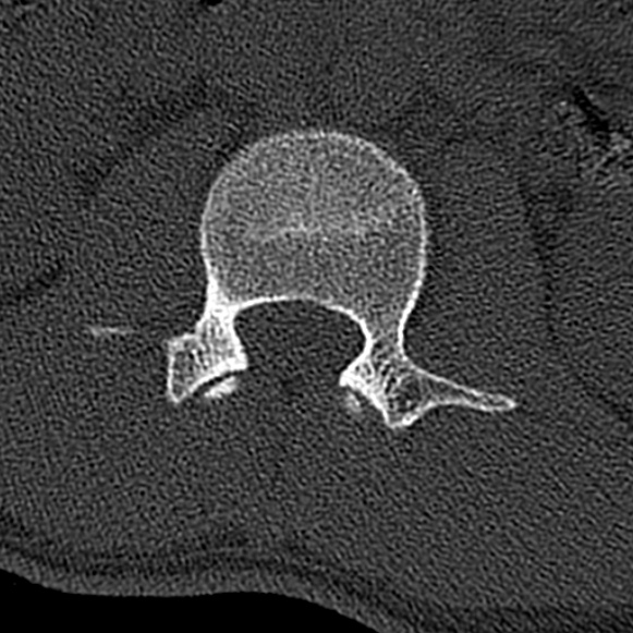 File:Burst fracture (Radiopaedia 53373-59357 Axial bone window 20).jpg