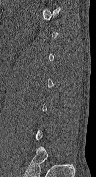 Burst fracture (Radiopaedia 53373-59357 Sagittal bone window 1).jpg