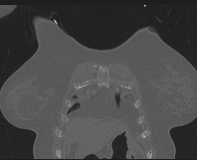 Burst fracture - thoracic spine (Radiopaedia 30238-30865 Coronal bone window 26).jpg