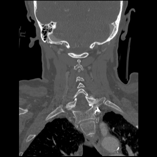 C1 anterior arch (plough) fracture - type 1 (Radiopaedia 76181-87720 Coronal bone window 35).jpg