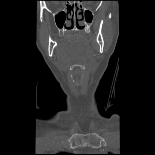 C1 anterior arch (plough) fracture - type 1 (Radiopaedia 76181-87720 Coronal bone window 89).jpg