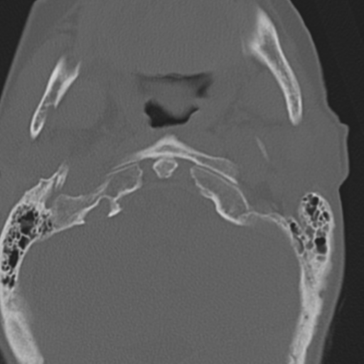 File:C2 fracture with vertebral artery dissection (Radiopaedia 37378-39199 Axial bone window 9).png