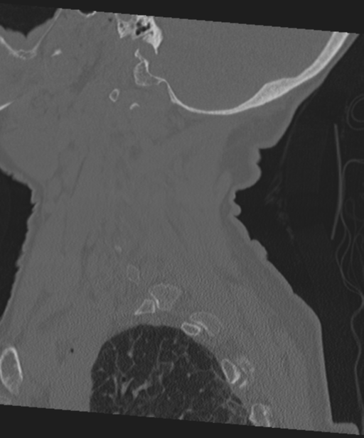 C2 fracture with vertebral artery dissection (Radiopaedia 37378-39199 Sagittal bone window 60).png