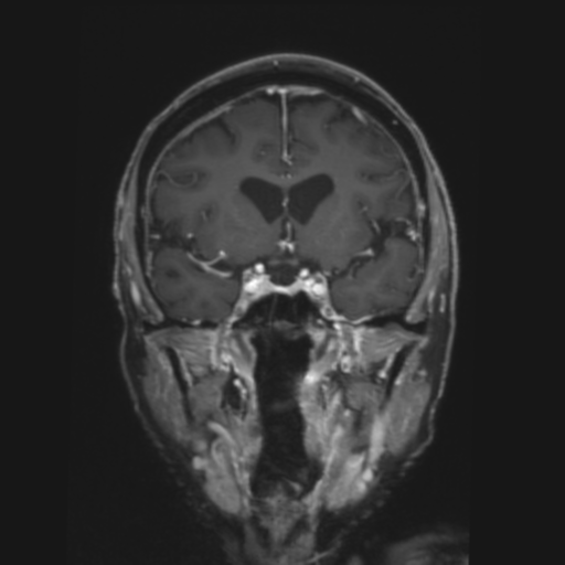 CNS lymphoma with steroid response (Radiopaedia 37980-39921 Coronal T1 C+ 16).png