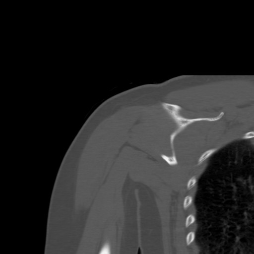 File:Calcific tendinitis of the infraspinatus tendon (Radiopaedia 87256-103539 Coronal bone window 39).jpg