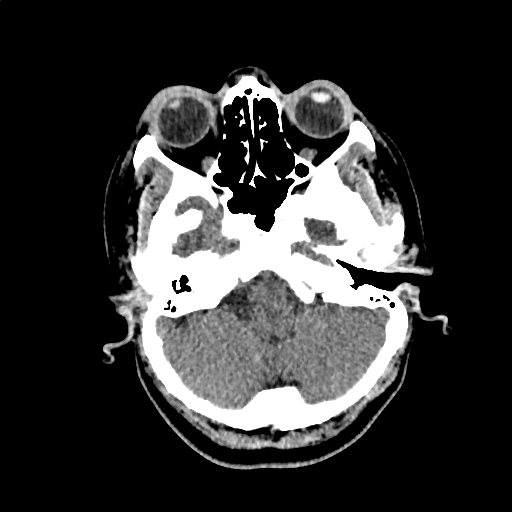 Calcified cerebral hydatid cyst (Radiopaedia 65603-74717 Axial non-contrast 7).jpg