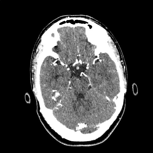 File:Calcified cerebral hydatid cyst (Radiopaedia 65603-74717 Axial with contrast 23).jpg