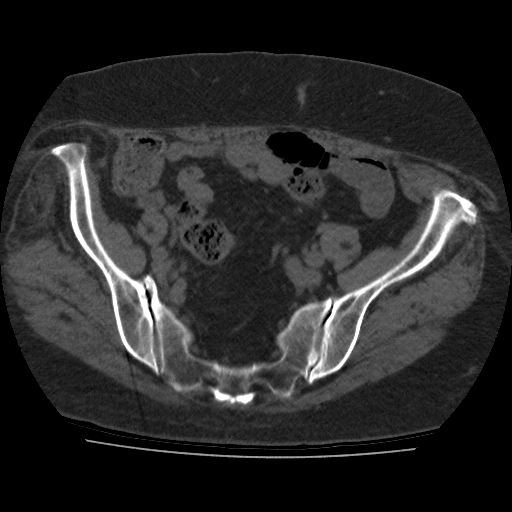 File:Calcified fibroids (Radiopaedia 16853-16579 non-contrast 1).jpg