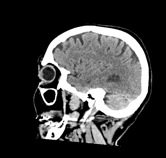 File:Calcified meningioma (Radiopaedia 74361-85243 D 16).jpg