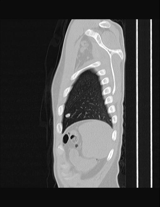 Calcifying pulmonary metastases (Radiopaedia 33359-34396 Sagittal lung window 7).jpg