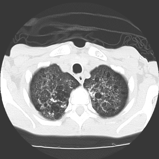 File:Calciphylaxis and metastatic pulmonary calcification (Radiopaedia 10887-11317 Axial lung window 2).jpg