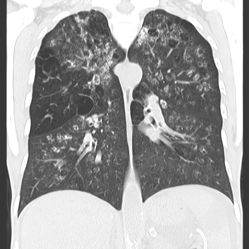 File:Calciphylaxis and metastatic pulmonary calcification (Radiopaedia 10887-11318 Coronal lung window 7).jpg