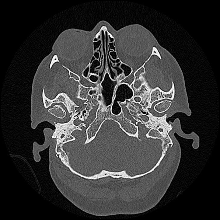 Canal up mastoidectomy (Radiopaedia 78108-90638 Axial bone window 40).jpg