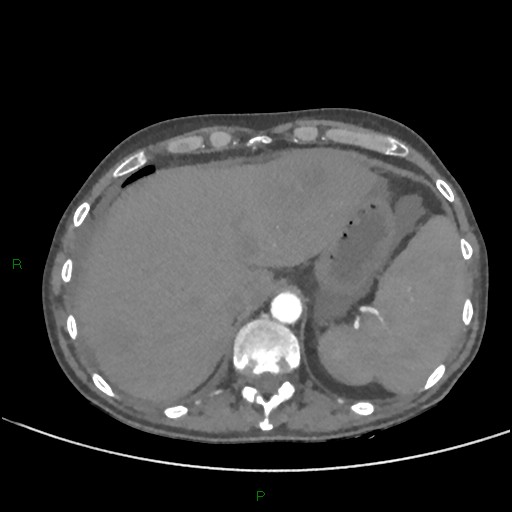 File:Cannonball metastases (Radiopaedia 82110-96150 Axial C+ CTPA 293).jpg