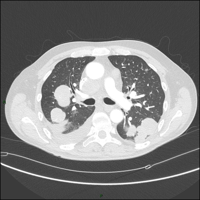 Cannonball metastases (Radiopaedia 82110-96150 Axial lung window 86).jpg