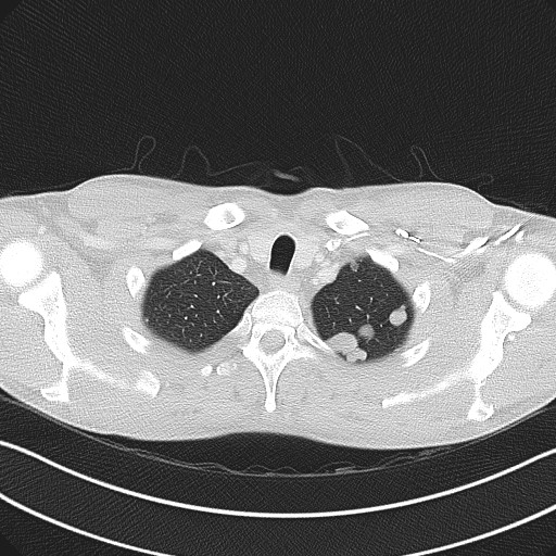 Cannonball metastases - testicular choriocarcinoma (Radiopaedia 84510-99891 Axial lung window 15).jpg