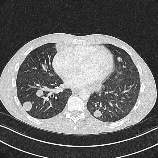 File:Cannonball metastases - testicular choriocarcinoma (Radiopaedia 84510-99891 Axial lung window 63).jpg