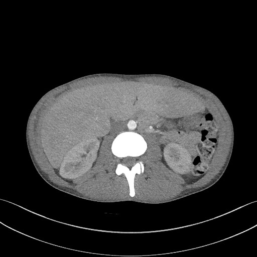 Cannonball metastases - testicular choriocarcinoma (Radiopaedia 84510-99891 B 127).jpg